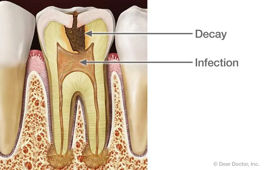Root Canal Treatment at East Greenwich Dental Associates, East Greenwich, Rhode Island.