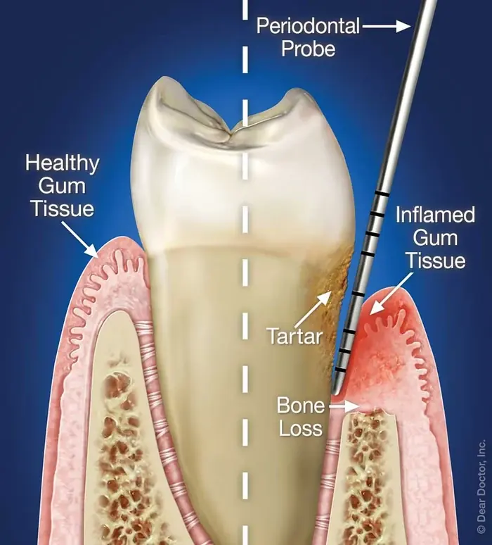 Gum Disease Treatment at East Greenwich Dental Associates, East Greenwich, Rhode Island.